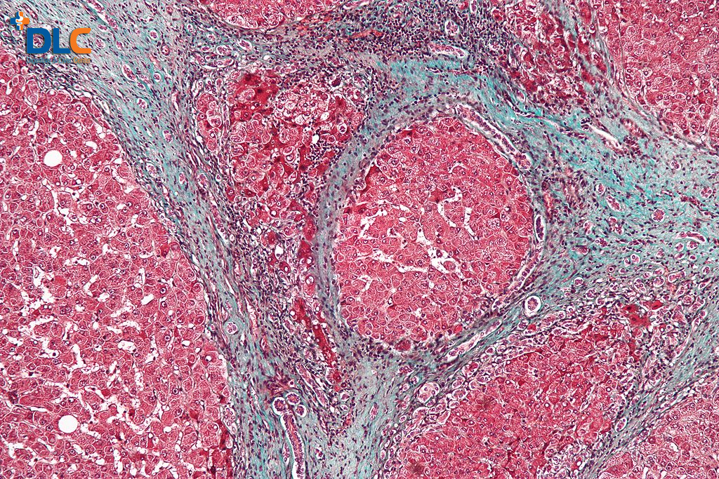 Ảnh chụp tế bào xơ gan (Nguồn: Wikipedia.com)